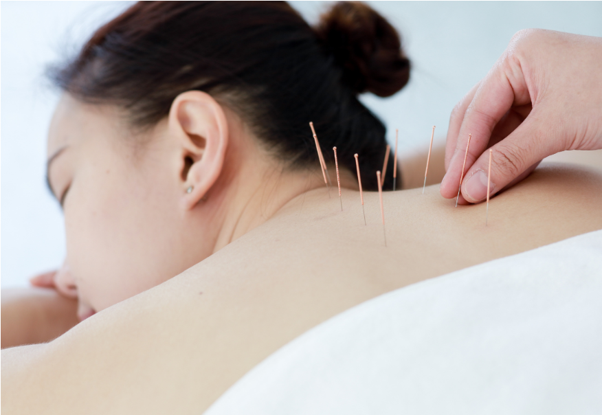 Acupuncture treatment